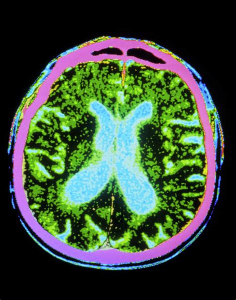 can a ct scan detect parkinson's disease